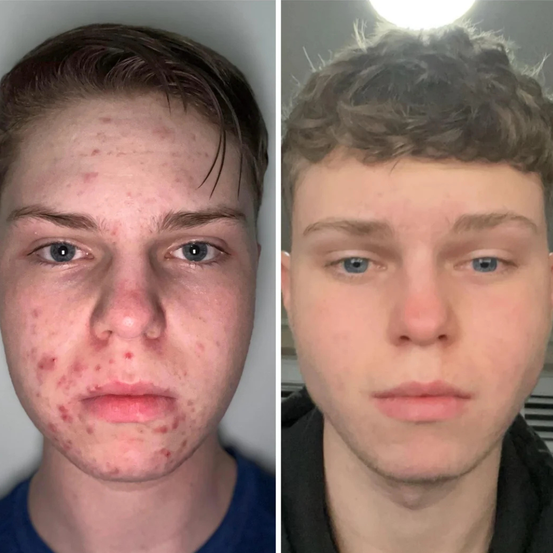 Acne Healing Patches (108)