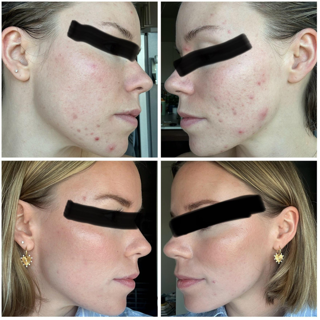 Acne Healing Patches (108)