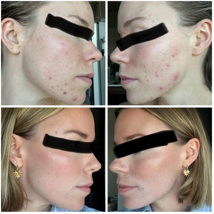 Acne Healing Patches (108)