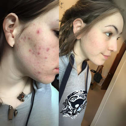 Acne Healing Patches (108)