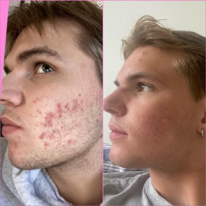 Acne Healing Patches (108)