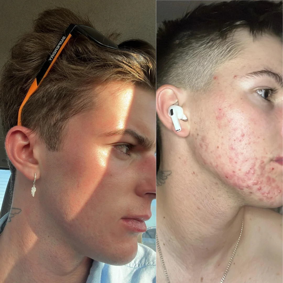 Acne Healing Patches (108)